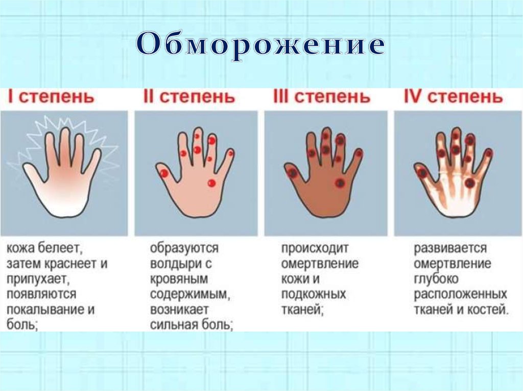 Лечение обморожений рук и ног в Приморском районе СПб